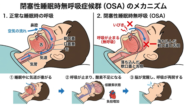 閉塞性睡眠時無呼吸症候群（OSA）のメカニズム